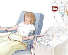 Membranlı plazmaferez xidməti