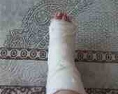 Sınıqçı xidməti